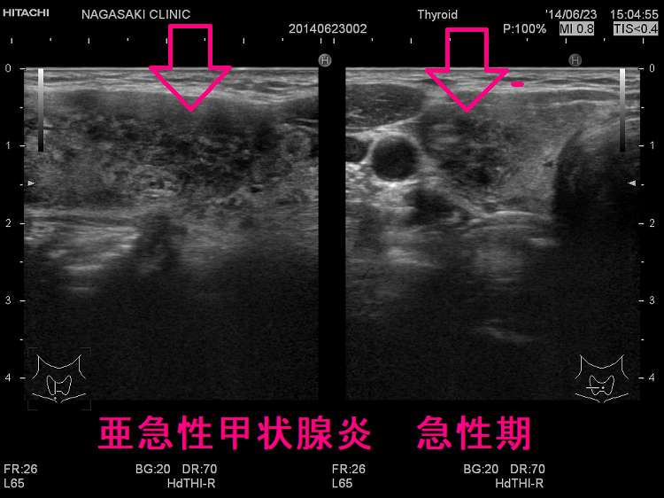 亜急性甲状腺炎　急性期　超音波(エコー)画像2