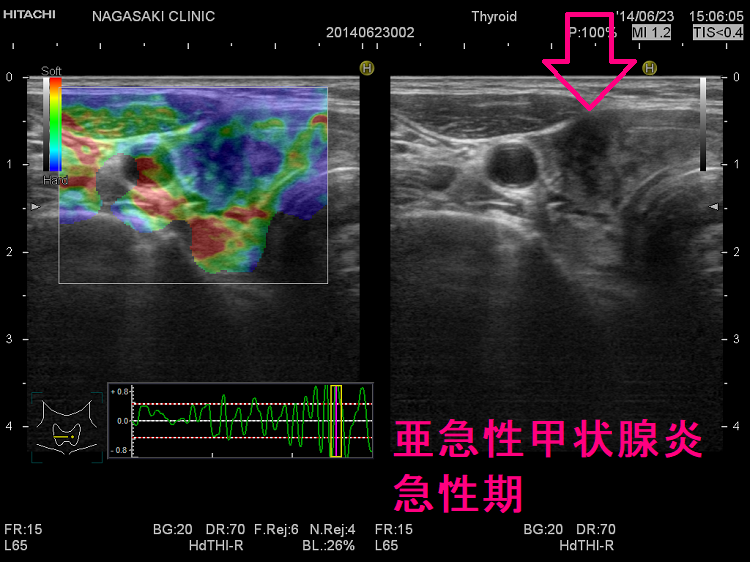 亜急性甲状腺炎の急性期 超音波(エコー)画像 エラストグラフィー