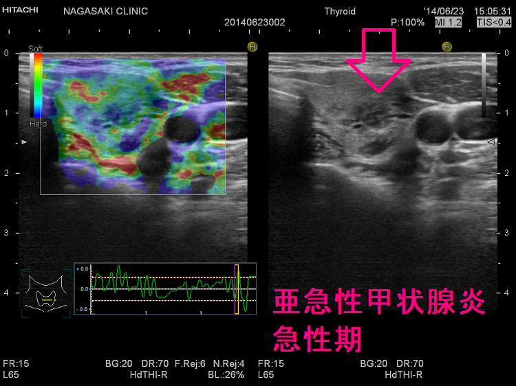亜急性甲状腺炎の急性期 超音波(エコー)画像 エラストグラフィー2