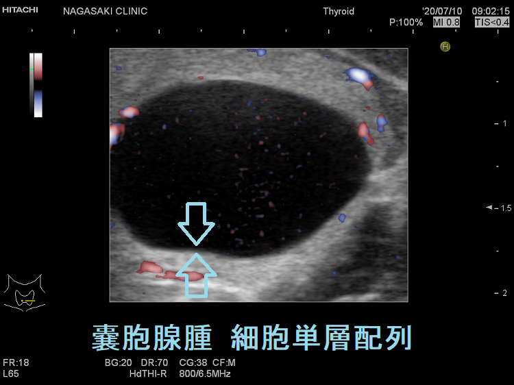 嚢胞腺腫 細胞単層配列 超音波(エコー)画像