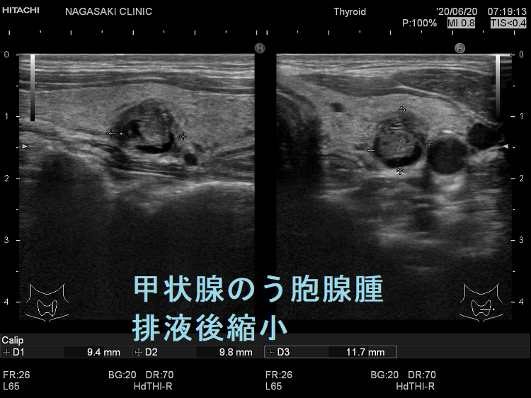 甲状腺のう胞腺腫 排液後縮小  超音波(エコー)画像