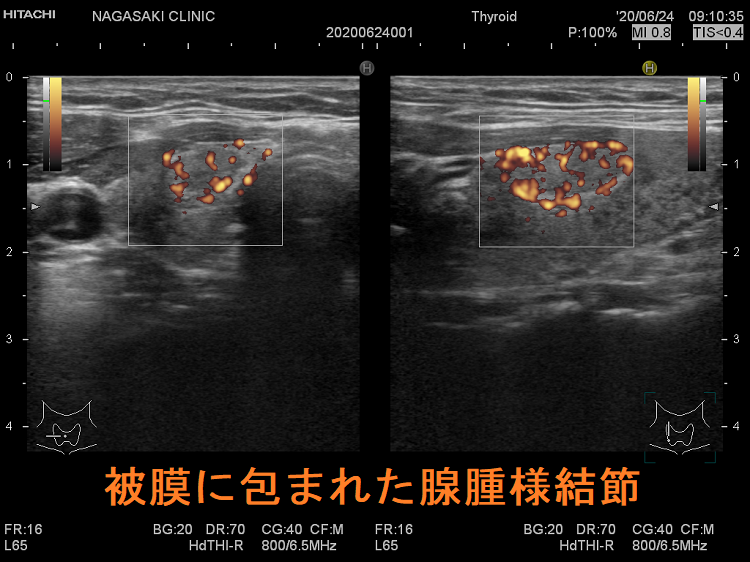 被膜に包まれた腺腫様結節 超音波(エコー)画像 ドプラーモード