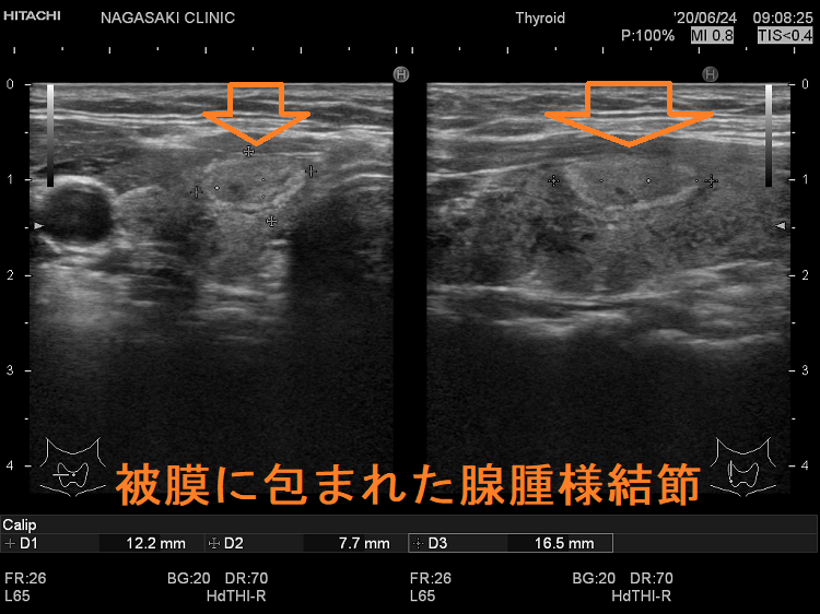 被膜に包まれた腺腫様結節 超音波(エコー)画像