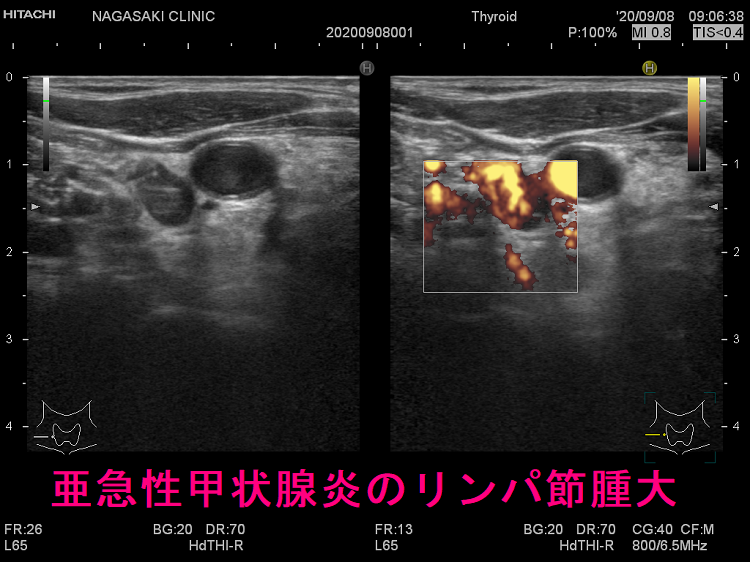 亜急性甲状腺炎患者の今後の見通しはどうなりますか?