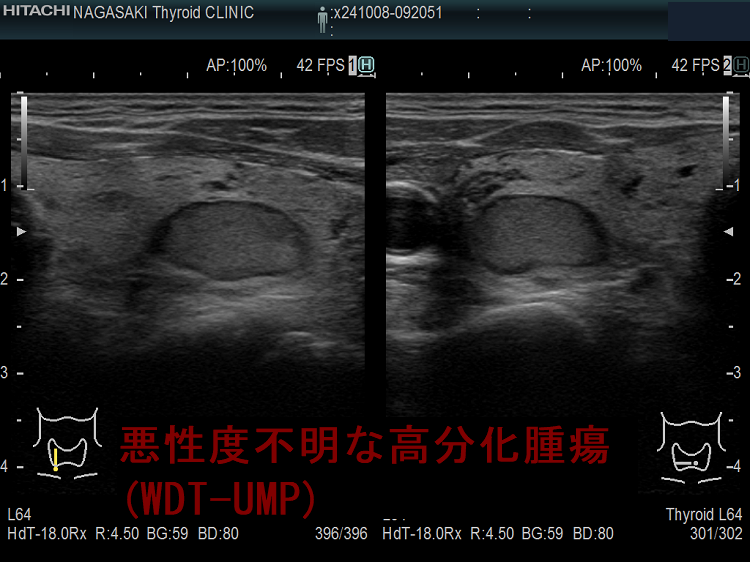 悪性度不明な高分化腫瘍(WDT-UMP) 超音波(エコー)画像 悪性度不明な高分化腫瘍(WDT-UMP) 超音波(エコー)画像