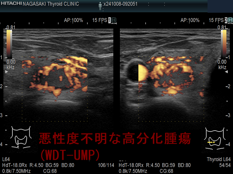 悪性度不明な高分化腫瘍(WDT-UMP) 超音波(エコー)画像 ドプラーモード 悪性度不明な高分化腫瘍(WDT-UMP) 超音波(エコー)画像 ドプラーモード