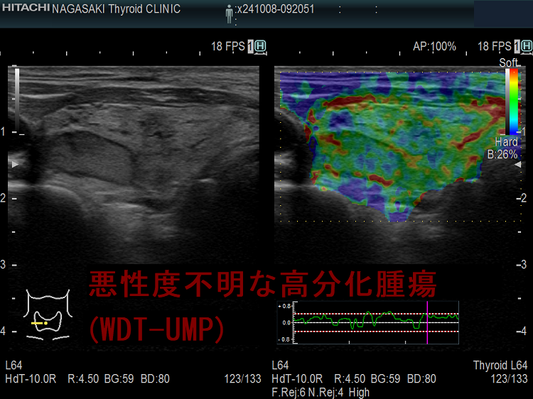 悪性度不明な高分化腫瘍(WDT-UMP) 超音波(エコー)画像 エラストグラフィー 悪性度不明な高分化腫瘍(WDT-UMP) 超音波(エコー)画像 エラストグラフィー