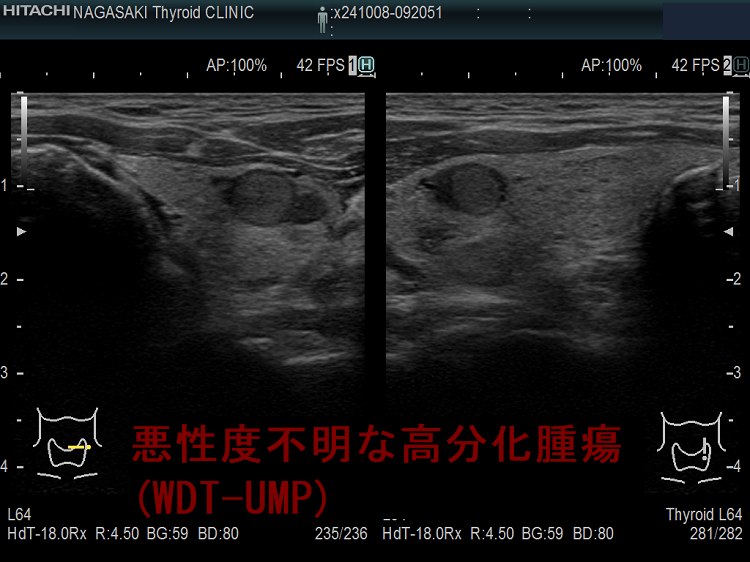 悪性度不明な高分化腫瘍(WDT-UMP) 超音波(エコー)画像 悪性度不明な高分化腫瘍(WDT-UMP) 超音波(エコー)画像