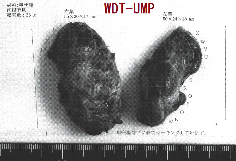 悪性度不明な高分化腫瘍(WDT-UMP) 手術標本 悪性度不明な高分化腫瘍(WDT-UMP) 手術標本