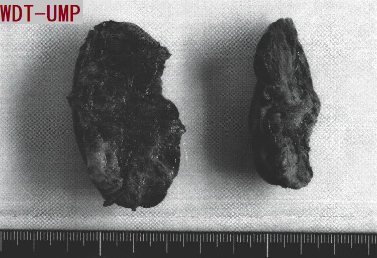 悪性度不明な高分化腫瘍(WDT-UMP) 手術標本 2 悪性度不明な高分化腫瘍(WDT-UMP) 手術標本 2