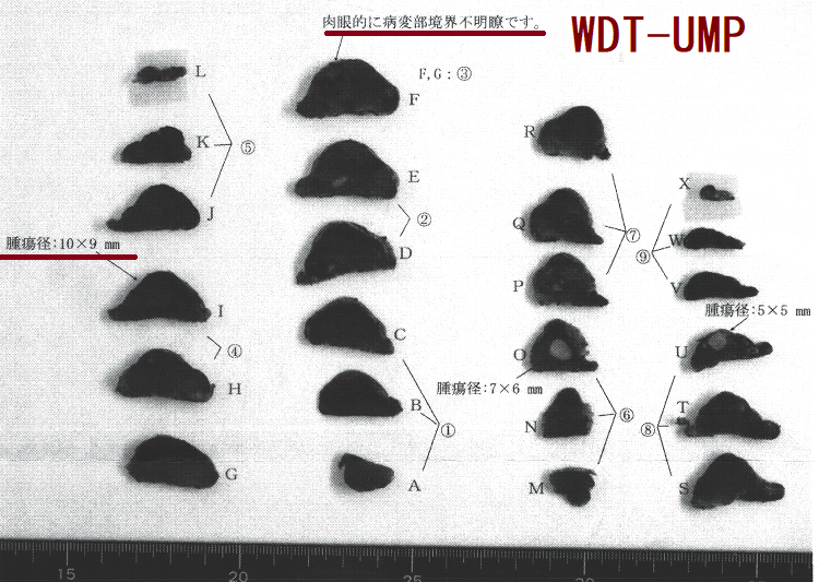 悪性度不明な高分化腫瘍(WDT-UMP) 手術標本 割断面 悪性度不明な高分化腫瘍(WDT-UMP) 手術標本 割断面