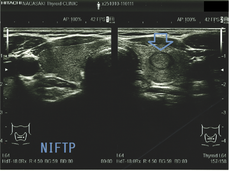 NIFTP 超音波(エコー)画像 (水平断) NIFTP 超音波(エコー)画像 (水平断)