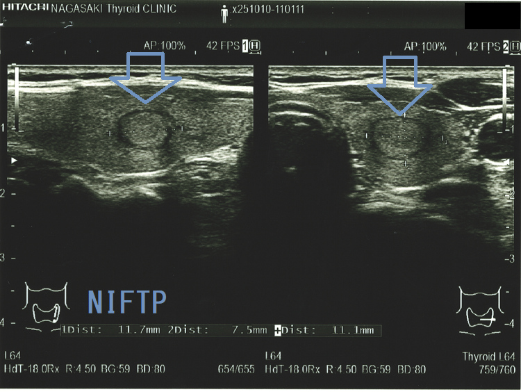 NIFTP 超音波(エコー)画像 NIFTP 超音波(エコー)画像