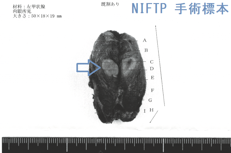NIFTP 手術標本2 NIFTP 手術標本2