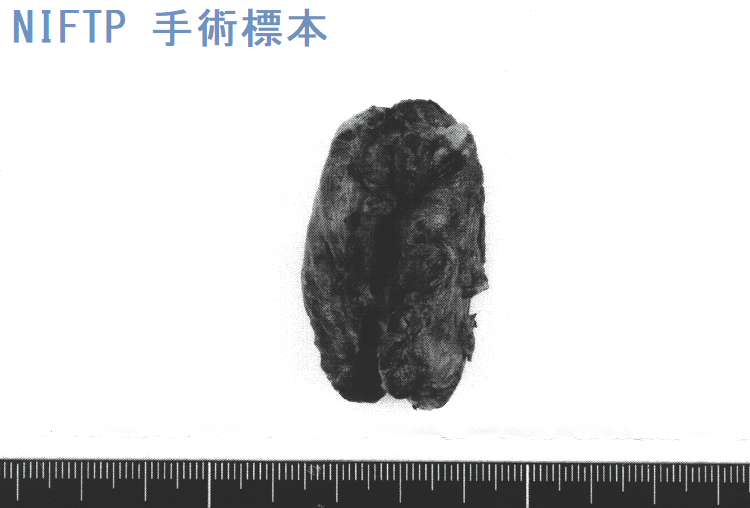 NIFTP 手術標本1 NIFTP 手術標本1