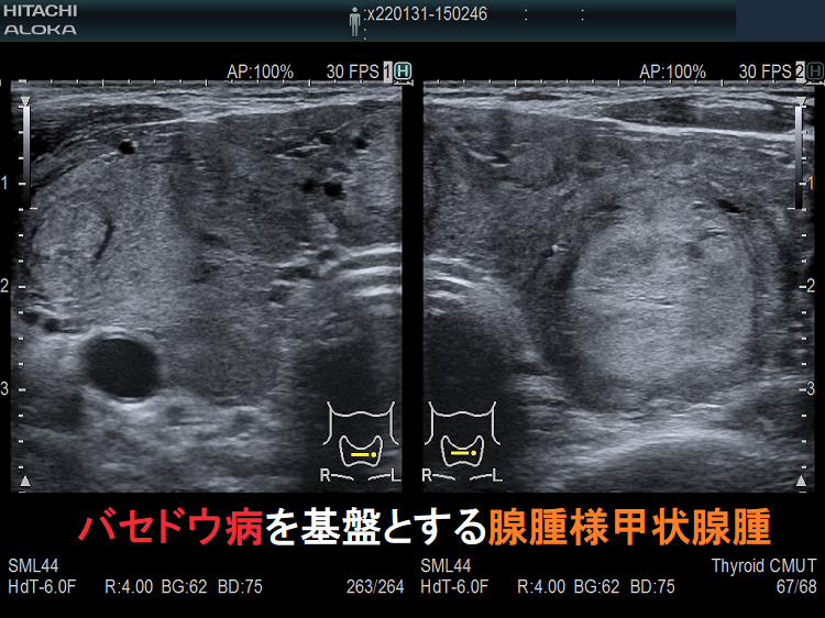 バセドウ病を基盤とする腺腫様甲状腺腫 超音波(エコー)画像