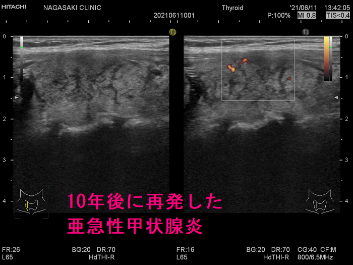 10年後に再発した亜急性甲状腺炎 超音波(エコー)画像 ドプラー
