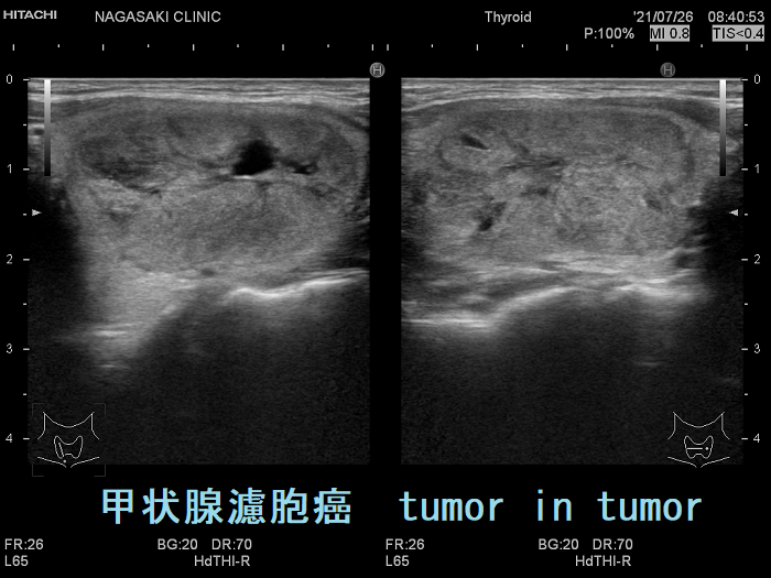 甲状腺濾胞癌　tumor in tumor　超音波（エコー）画像