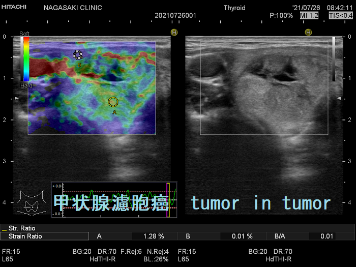 甲状腺濾胞癌 tumor in tumor エラストグラフィー