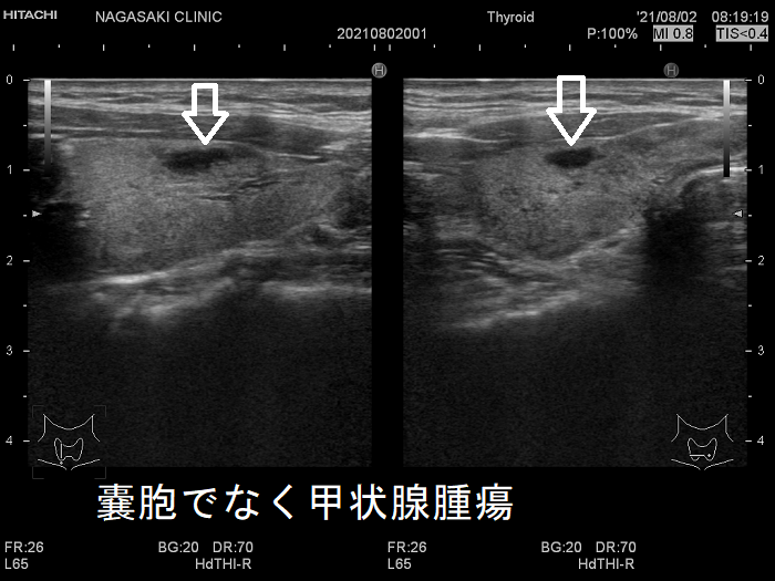 嚢胞でなく甲状腺腫瘍 超音波(エコー)画像 
