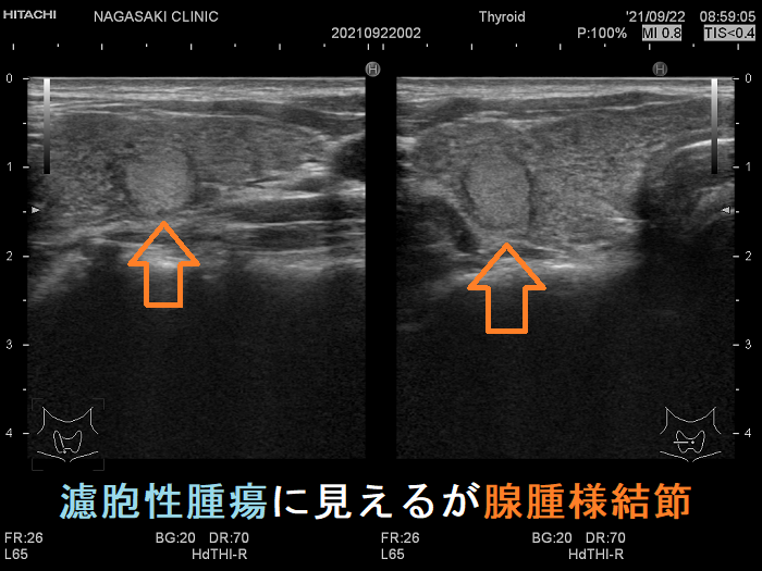 濾胞性腫瘍に見えるが腺腫様結節　超音波(エコー)画像