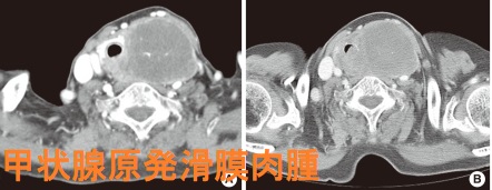 甲状腺原発滑膜肉腫&lrm;&lrm; CT画像