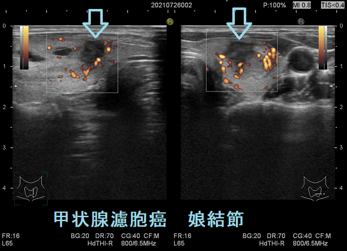 甲状腺濾胞癌（娘結節）超音波（エコー）画像 ドプラー