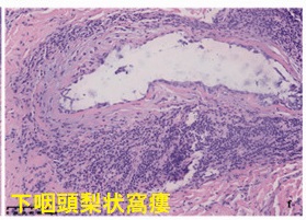 甲状腺腫瘍・甲状腺癌のように見える下咽頭梨状窩瘻 組織像