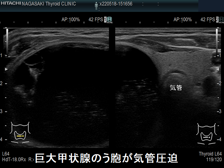 巨大甲状腺のう胞が気管圧迫 超音波(エコー)画像