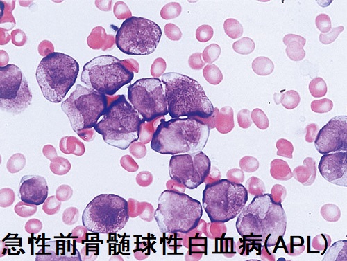 急性前骨髄球性白血病(APL)