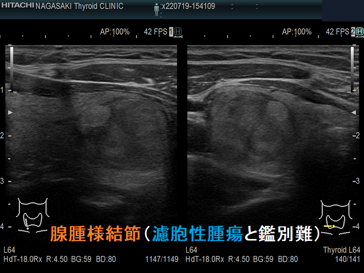腺腫様結節（濾胞性腫瘍と鑑別難）超音波(エコー)画像