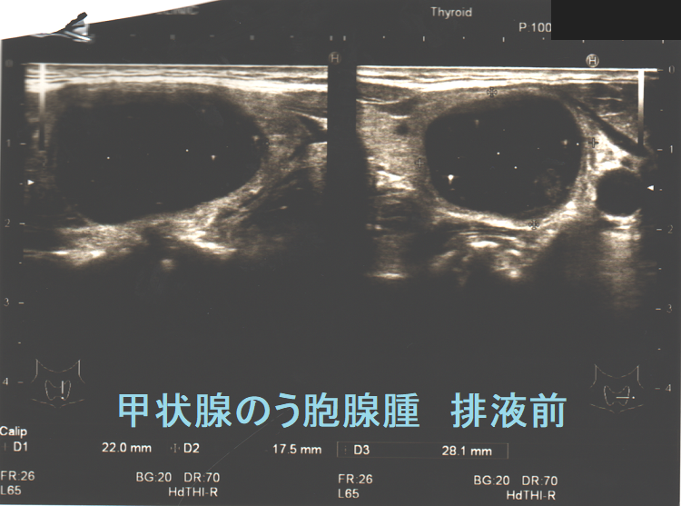 排液前の甲状腺のう胞腺腫 超音波(エコー)画像