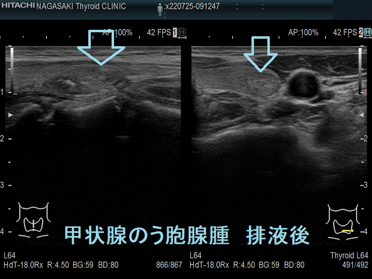 排液後縮小した甲状腺のう胞腺腫 超音波(エコー)画像