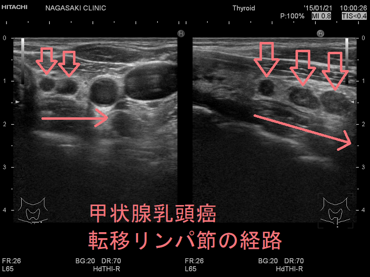 甲状腺乳頭癌　転移リンパ節の経路 超音波（エコー）画像