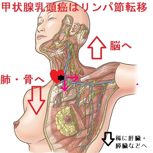 甲状腺乳頭癌　転移リンパ節の経路