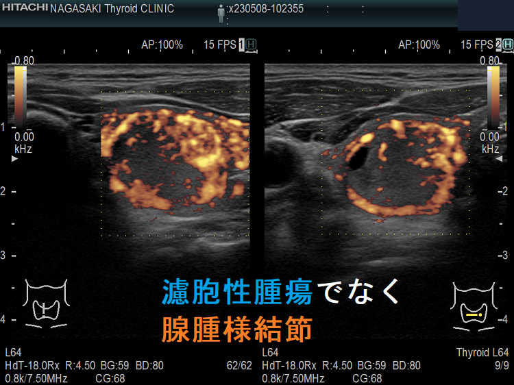 濾胞性腫瘍に見えるが腺腫様結節 超音波(エコー)画像 ドプラーモード