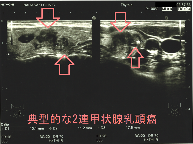 典型的な2連甲状腺乳頭癌 典型的な2連甲状腺乳頭癌