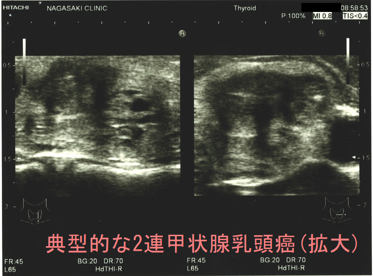 典型的な2連甲状腺乳頭癌(拡大) 典型的な2連甲状腺乳頭癌(拡大)