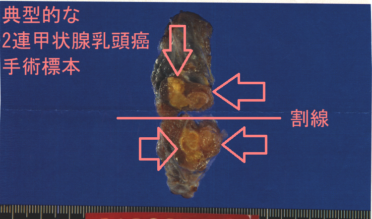 典型的な2連甲状腺乳頭癌 手術標本 典型的な2連甲状腺乳頭癌 手術標本1