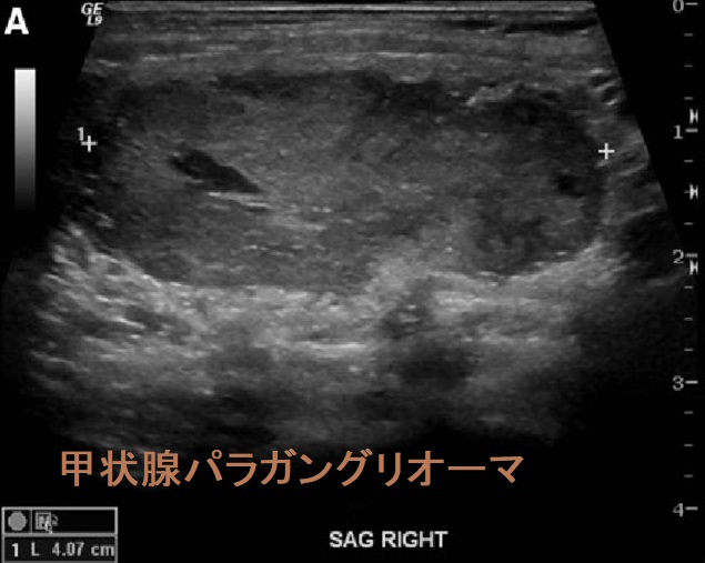 甲状腺パラガングリオーマ超音波(エコー)画像