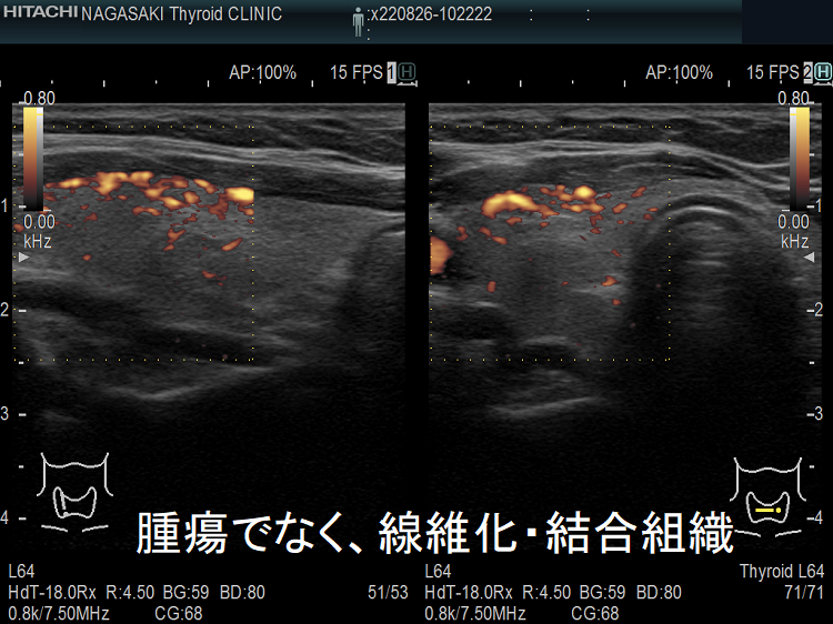 甲状腺腫瘍でなく、線維化・結合組織 超音波(エコー)画像 ドプラーモード