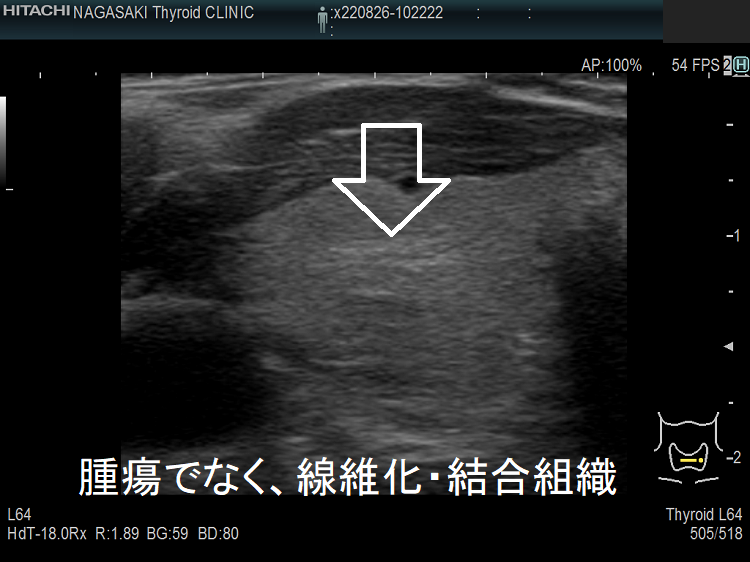 甲状腺腫瘍でなく、線維化・結合組織 超音波(エコー)画像 拡大