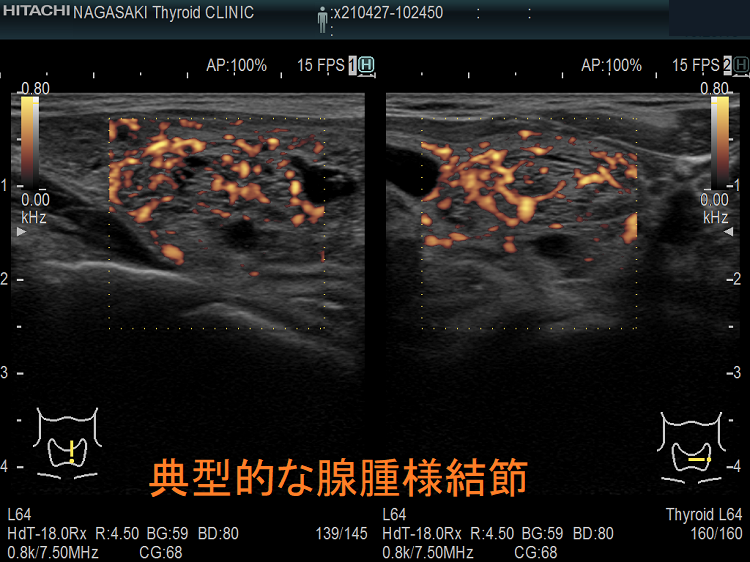 典型的な腺腫様結節 超音波(エコー)画像2