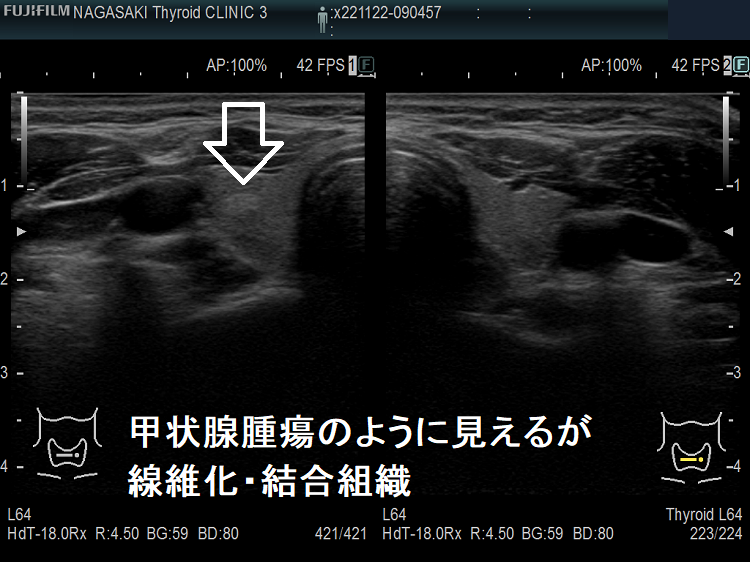 甲状腺腫瘍のように見えるが、線維化・結合組織  超音波(エコー)画像