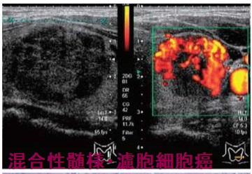 混合性髄様・濾胞細胞癌（MMFC）  超音波(エコー)画像