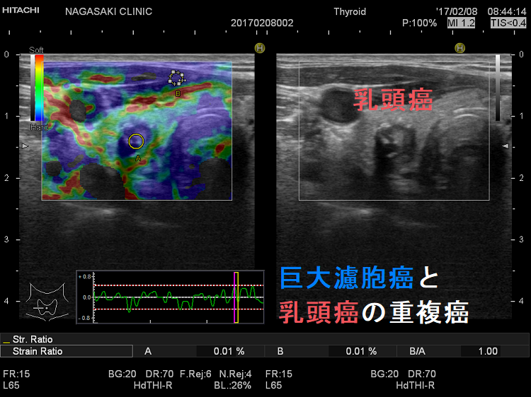 甲状腺濾胞癌と甲状腺乳頭癌の重複癌 超音波（エコー）画像