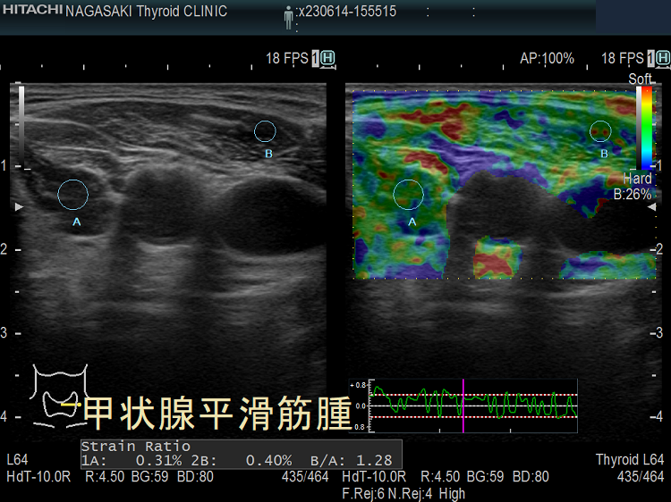 甲状腺平滑筋腫 超音波(エコー)画像 エラストグラフィー