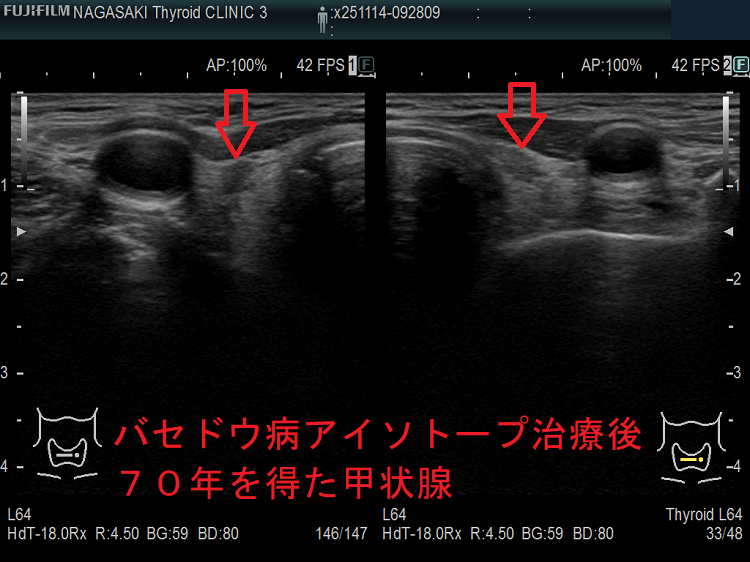 バセドウ病アイソトープ治療後70年を得た甲状腺(水平断) バセドウ病アイソトープ治療後70年を得た甲状腺(水平断)