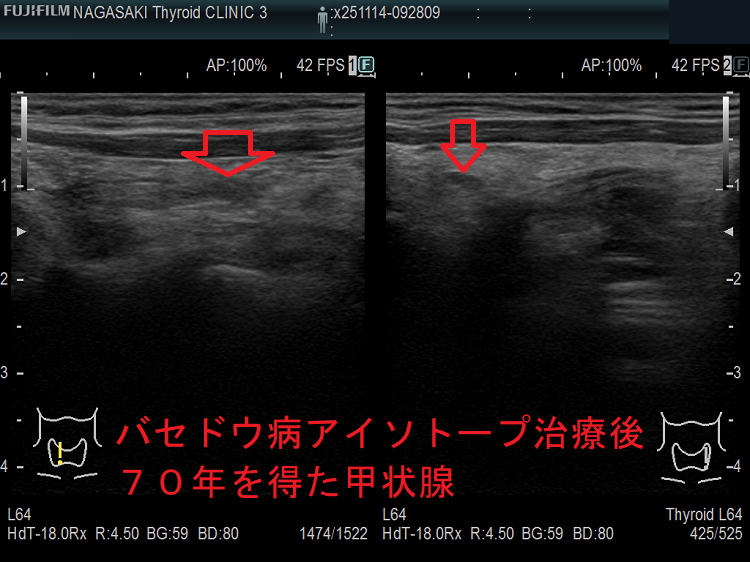 バセドウ病アイソトープ治療後70年を得た甲状腺(矢状断) バセドウ病アイソトープ治療後70年を得た甲状腺(矢状断)