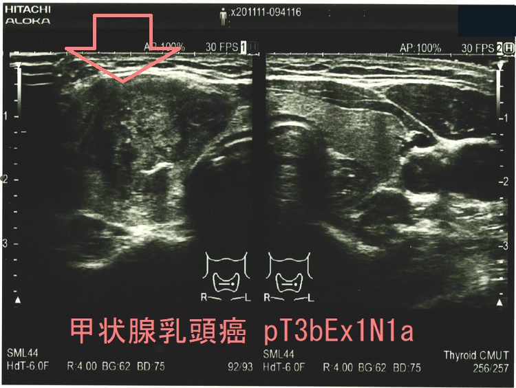 甲状腺乳頭癌 pT3bEx1N1a (水平断) 超音波(エコー)画像 甲状腺乳頭癌 pT3bEx1N1a (水平断) 超音波(エコー)画像